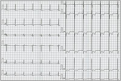 Late-Stage Löffler's Endocarditis Mimicking Cardiac Tumor: A Case Report